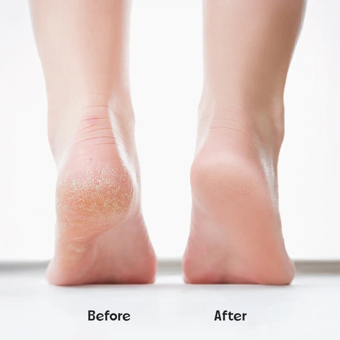 Professional Foot Cleaner for Dead Skin - Callus Remover + Free Moisturizing Foot Socks