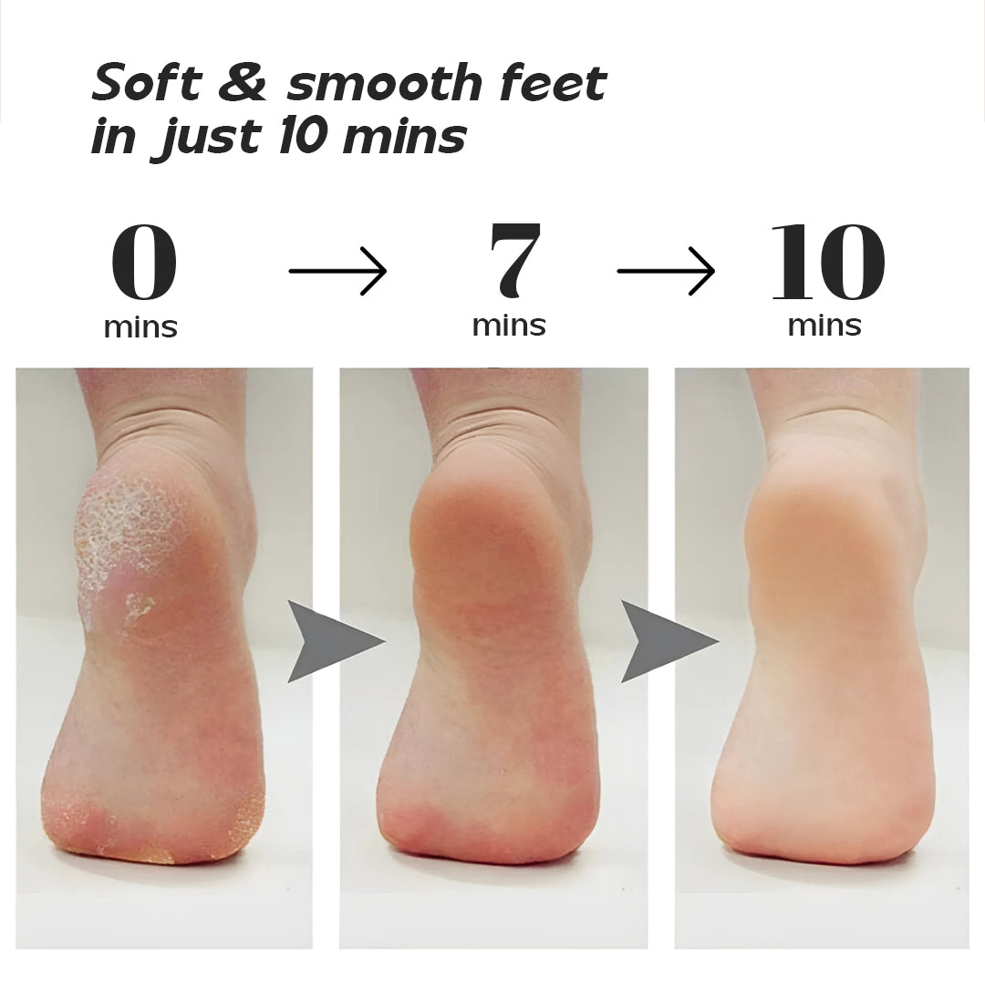 Professional Foot Cleaner for Dead Skin - Callus Remover + Free Moisturizing Foot Socks